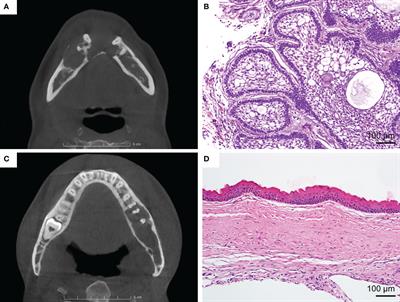 Improved Diagnostic Accuracy of Ameloblastoma and Odontogenic Keratocyst on Cone-Beam CT by Artificial Intelligence